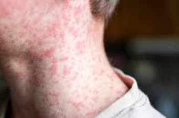 বাংলাদেশে হাম পরিস্থিতি: বৈশ্বিক অগ্রগতির বিপরীতে উদ্বেগজনক চিত্র, করণীয় কী?