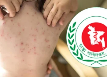 হামের উপসর্গ নিয়ে প্রাণ গেল আরও ৪ শিশুর