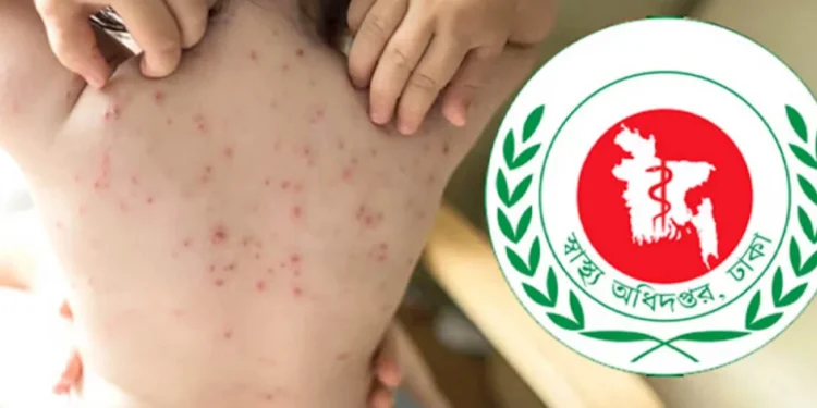 হামের উপসর্গ নিয়ে প্রাণ গেল আরও ৪ শিশুর