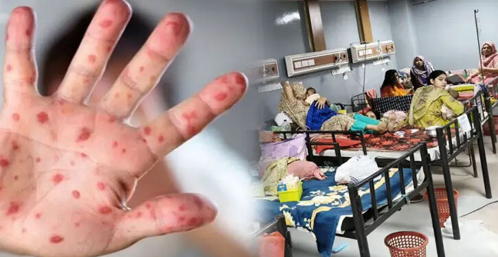 হাম, মিজলস ও রুবেলা কী একই রোগ? চিকিৎসকের সতর্কতা