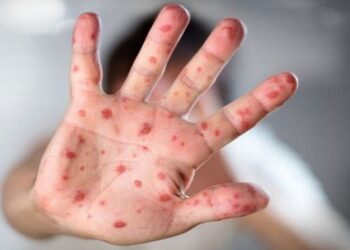 দেশে হাম ও হাম সন্দেহে শিশু মৃত্যু ২৫০ ছাড়াল