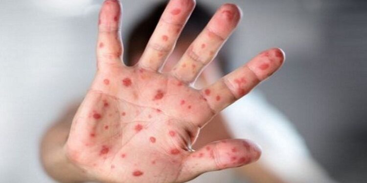 দেশে হাম ও হাম সন্দেহে শিশু মৃত্যু ২৫০ ছাড়াল