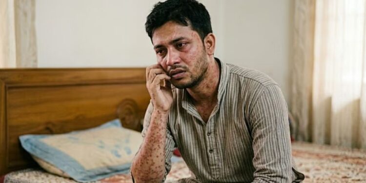 হাম হতে পারে বড়দেরও, জেনে নিন কী করবেন